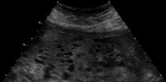 Caz extrem de rar: fată de 12 ani din Vrancea, la spital, cu o sarcină molară