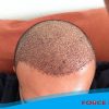 implant forcehair