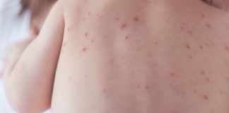S-a înregistrat primul deces de rujeolă: un bebeluș de 7 luni