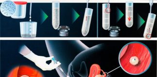 Bani alocați pentru continuarea programului de fertilizare in vitro