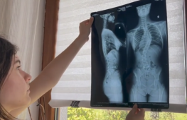 „Vreau doar să nu mă mai doară.” Diana are 12 ani și luptă cu o deformare severă a coloanei vertebrale 2 umanitar diana