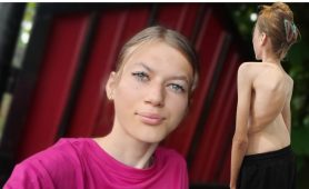 Umanitar: La 16 ani, Denisa are nevoie de ajutor pentru operația care îi poate reda șansa la o viață normală 2 denisa umanitar 2